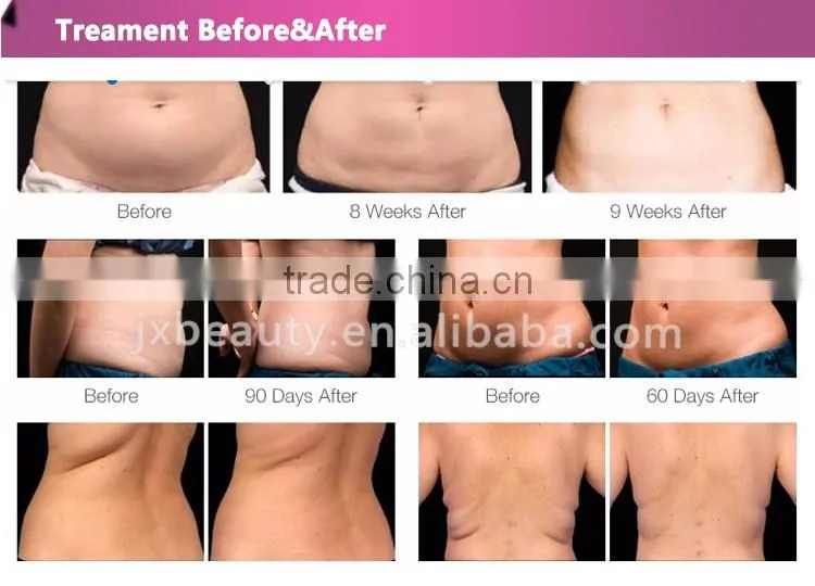 liposuction ultrasonic machine that remove belly fat