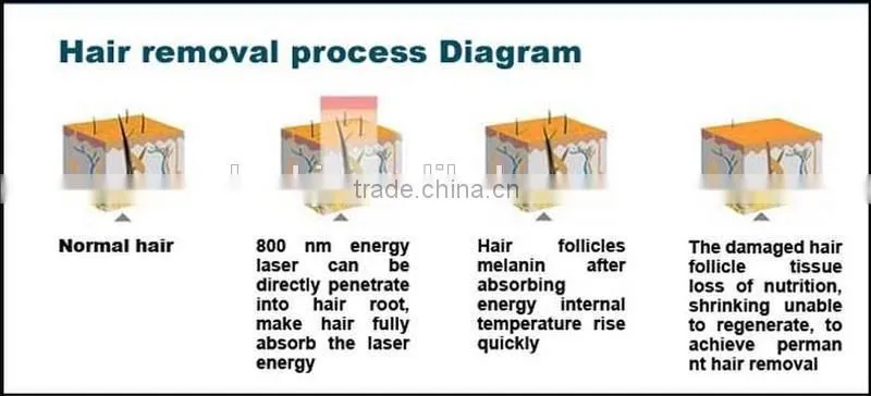 Super cooling! high quality diode 808nm laser hair remover / diode laser