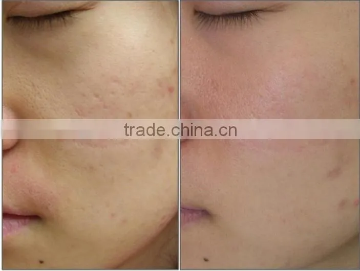 multifunctional jet peel machine skin rejuvenation Oxygen jet peel beauty equipment