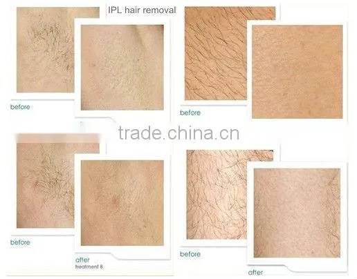New products ipl hair removal machine with ipl with xenon lamp