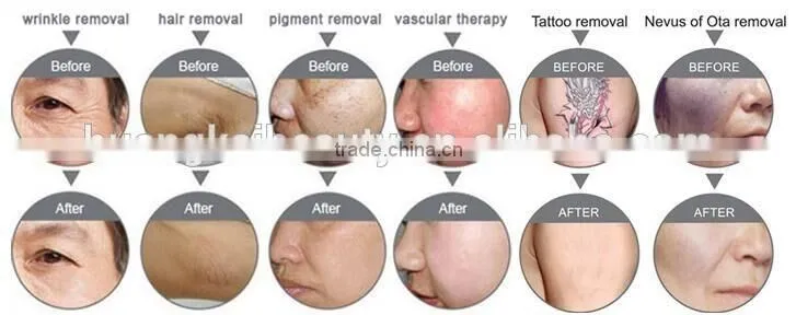 permanent ipl hair removal for men