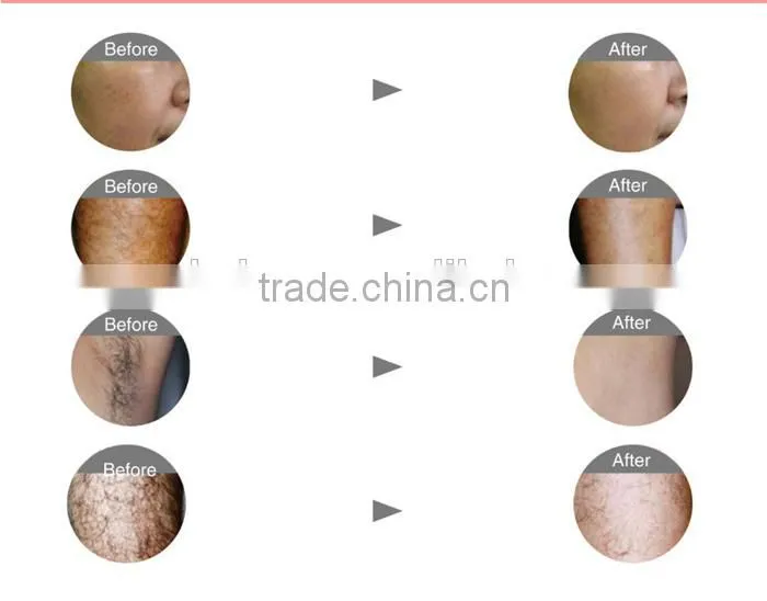 Safe And Effective Portable 808 Diode Laser Treatment For Unwanted Hair Removal From Face By Laser