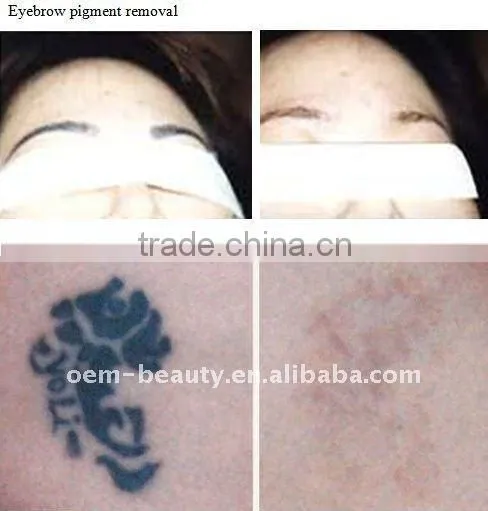 Pro Q Switched nd yag laser tattoo removal machine with 1064nm and 532nm treatment tips