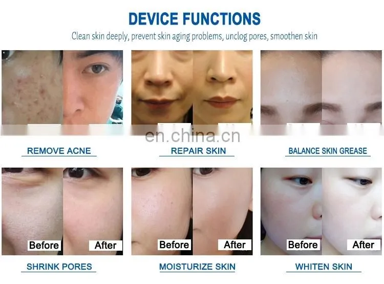 New 5 in 1 Big Bubble Oxygen Jet Facial Rejuvenation Spa Water Skin Care Machine