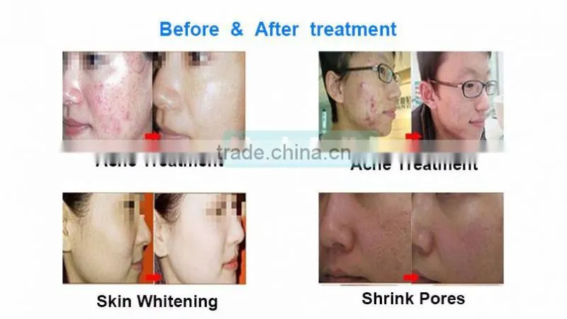 Top Quality Microdermabrasion Machine Portable Skin Revitalizer for Sale