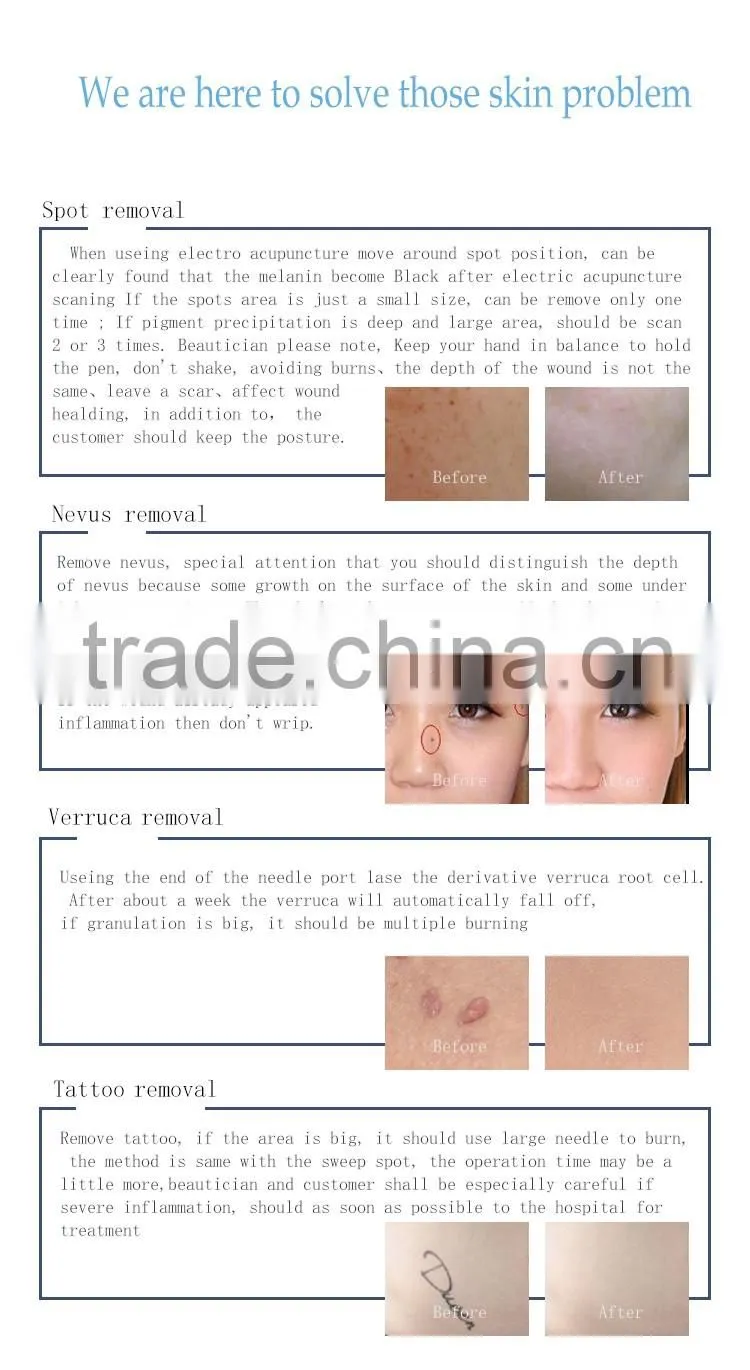 2016 Latest High-tech skin tag wart spot removal beauty pen for skin care with CE cetificate