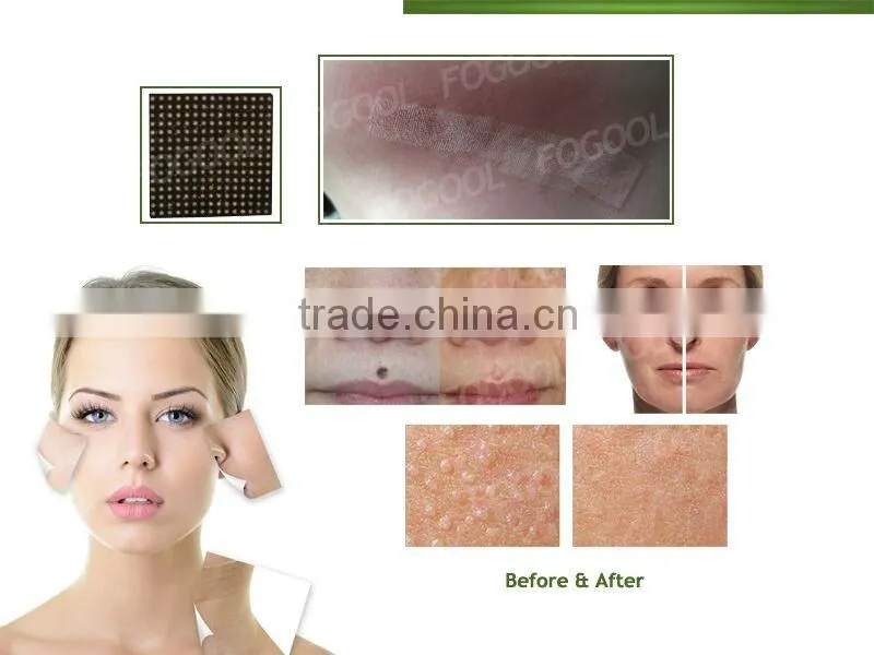 1540nm erbium glass fractional laser/ 1550nm erbium glass fiber laser fogool beijing