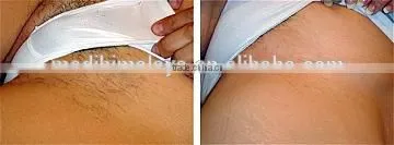 New design best price aesthetic diode laser machine for hair removal
