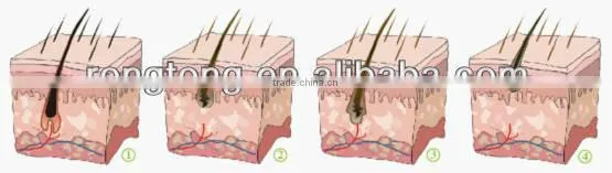 Portable IPL hair removal Medical CE Approved Med-100