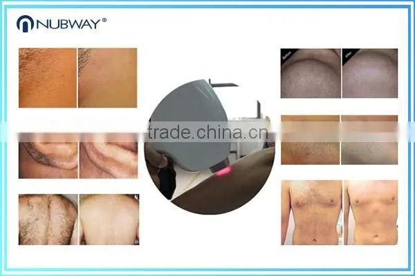Big Spot 808nm alexandrite Laser Diode Laser Hair Removal Machine