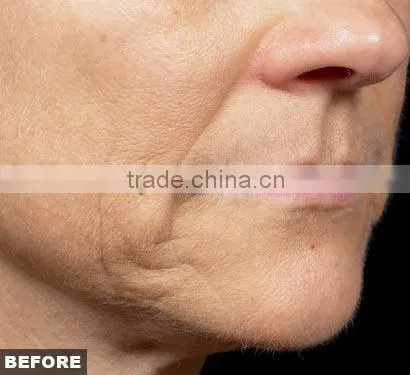Hot Fractional & Micro needle RF machine wrinkle removal, face lifting/fractional microneedle radiofrequency