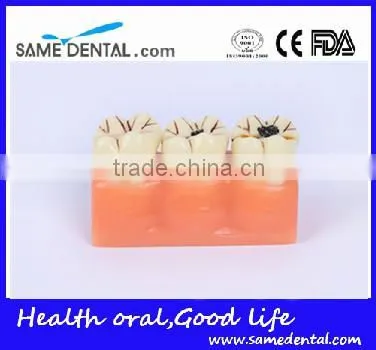 4 times the cavities progress model Dental Eduction Assitant No. DEA-16