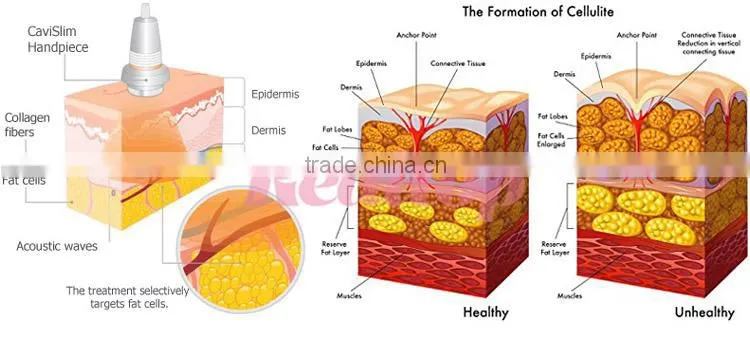 ultrasonic cavitation beauty slimming machine ,cavitation rf vacuum beauty equipment