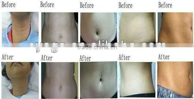 Ultra cavitation machine beauty supply outlet