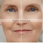 the lasest technology yag laser hair removal machine