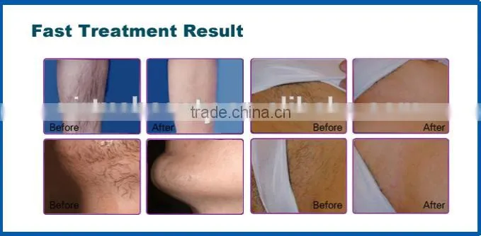 CE approved 755nm laser Alexandrite hair removal machine