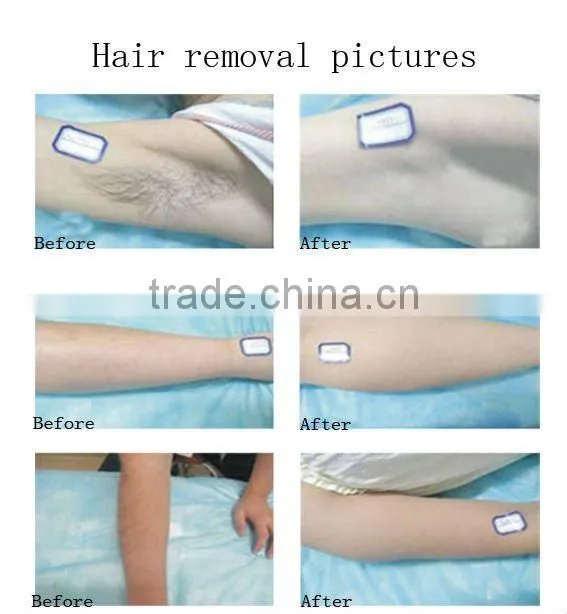 808nm Diode Laser Hair Removal Little to no chance of side effects