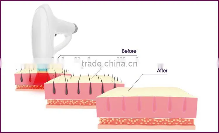 2016 Alibaba China new technology/Permanent/Hair removal/alexandrite hair removal machine
