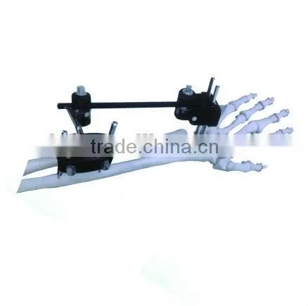 Radial Articular Fracture External Fracture Fixators