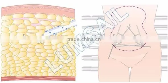 Cosmetic Surgery Equipment Surgical liposuction Liposuction Machine