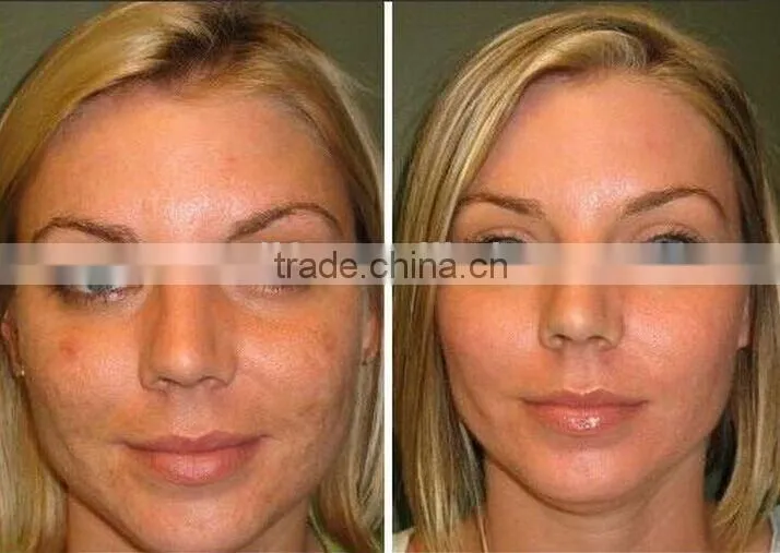NL-RUV500 Cellulite Reduction Eye Wrinkle Removal ultrasonic cavitation slimming machine