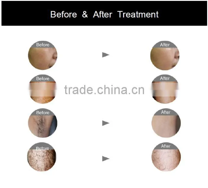 pain free laser hair removal/diode laser 808 nm salon machine