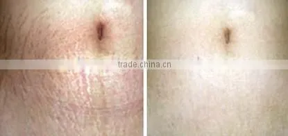 Hot selling auto micro needle system stretch mark removal