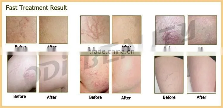 Technology 2016 varicose vein removal 980 vascular therapy machine