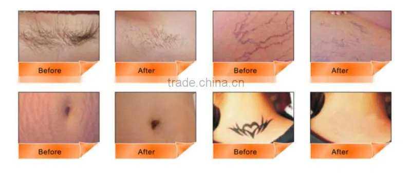Most competitive multifunction beauty system hair removal tattoo removal IPL RF ND YAG Laser