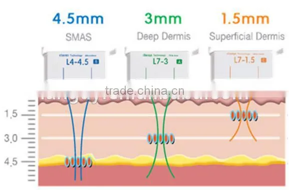 High Frequency Operation System and Anti-Puffiness/Skin Tightening/Wrinkle Remover Feature HIFU Face Lift