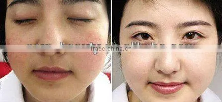 HOT!!!Vertical ipl beauty hair removal machine C006 favourite price