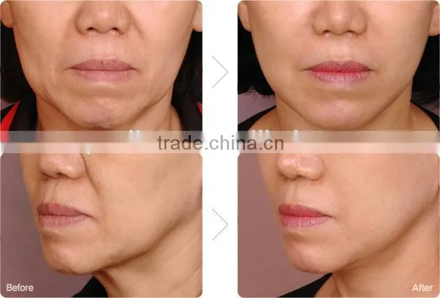 High Intensity Focus Ultrasound HIFU for Face and Neck Lift Without Surgery