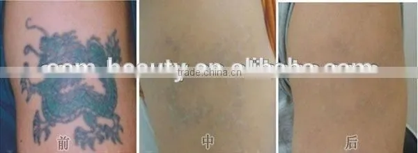 Newest laser tattoo removal machine permanent and pain free tattoo removal