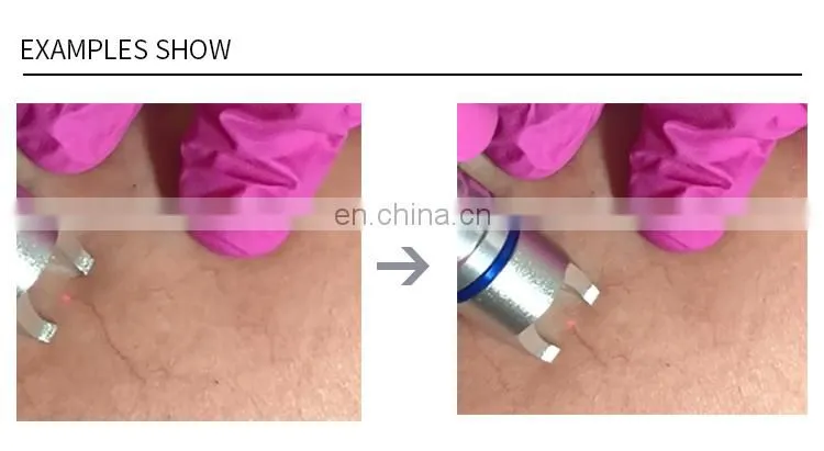 New Arrival Spider Vein Removal Machine 980 nm Diode Laser Vascular Removal Skin Care Beauty Instrument