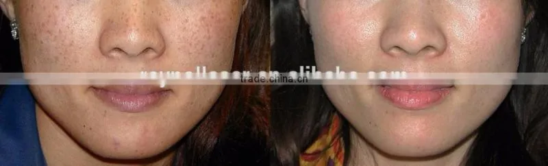 Import Laser Generator 755nm Alexandrite Laser Machines