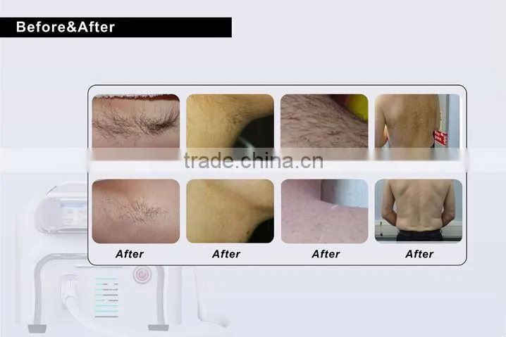 Portable 808nm diode laser permanent hair removal/epilation/depilation machine