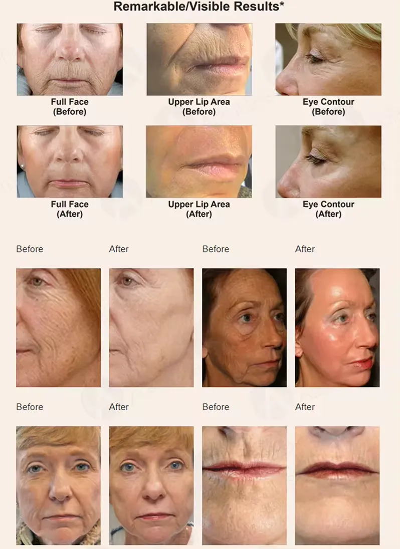 Ce Approved Fractional CO2 Laser Skin Resurfacing Machine CO2 Laser Vaginal Rejuvenation Machine Fractional Co2 Laser Price