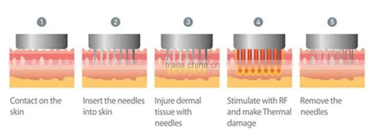 OEM service Professional portable fractional rf microneedle therapy machine for acne scars