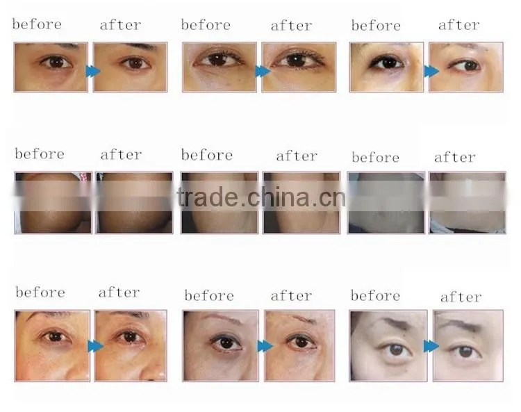 factory direct sale clinic use remove dark circles under eyes carboxy therapy equipment