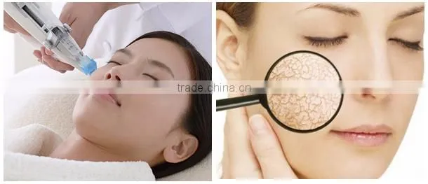 Mesogun skin whitening remove wrinkles vc injection machine price