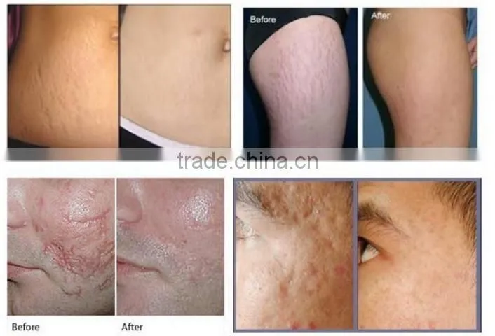 Professional Co2 for Skin Resurfacing Acne Scar Treatment