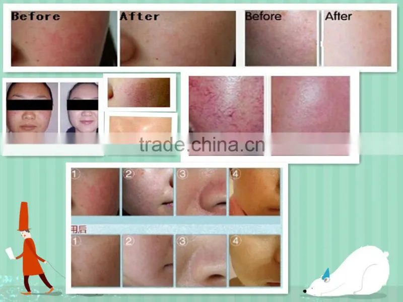 Beijing alexandrite laser 755nm hair removal equipment ruby laser