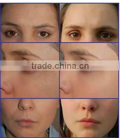 Wholesale 3 in 1 ipl Elight rf Nd Yag Laser hair removal beauty equipment CE