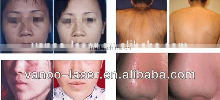 Beauty Hair Removal Personal Care IPL laser machine