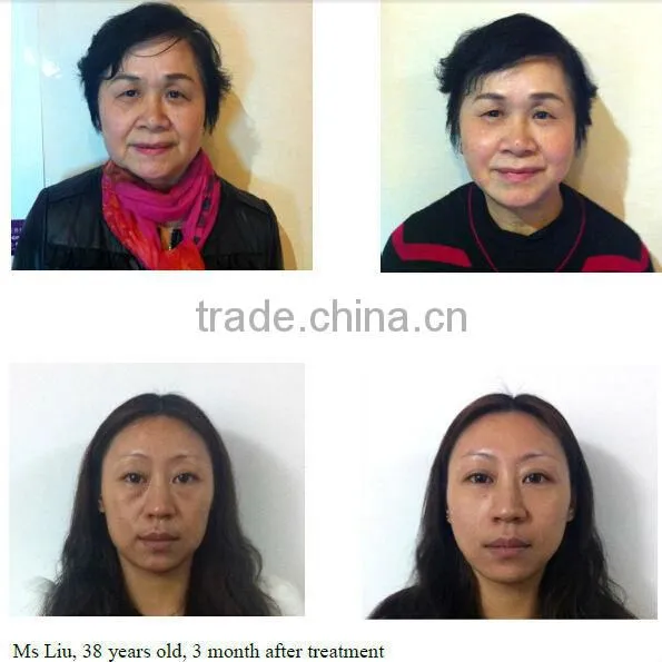 Significant effect thermagic skin tightening RF machine