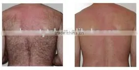 Lingmei 808nm diode laser permanent hair removal laser