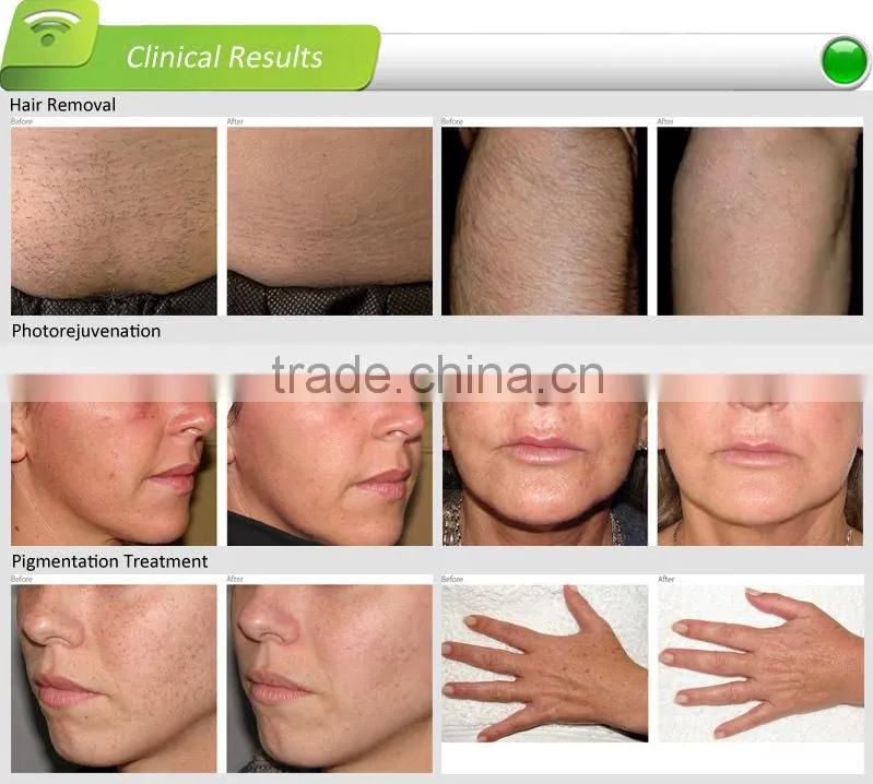IPL beauty machine,Multifunctional and perfect hair removal equipment with 100000shots life span,IPL portable