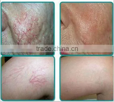 Spider vascular vein removal machine 980nm Diode Laser varicose veins machine