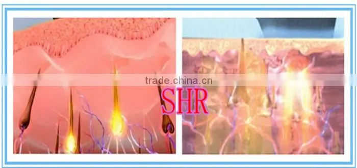 10 milliion shots lazer hair removal 808nme light laser hair removal machine