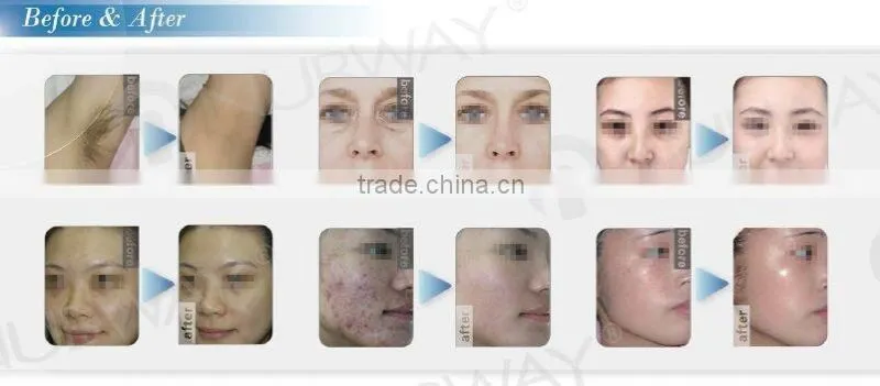 Laser hair removal fda approved ipl laser machine